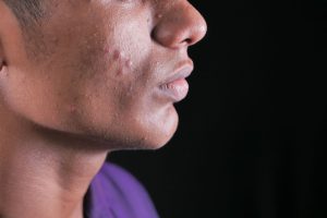HIV 感染者外表:能从外表看出来一个人感染了艾滋吗 1 HIV 感染者外表:年轻人脸上可见痘痘的侧面照